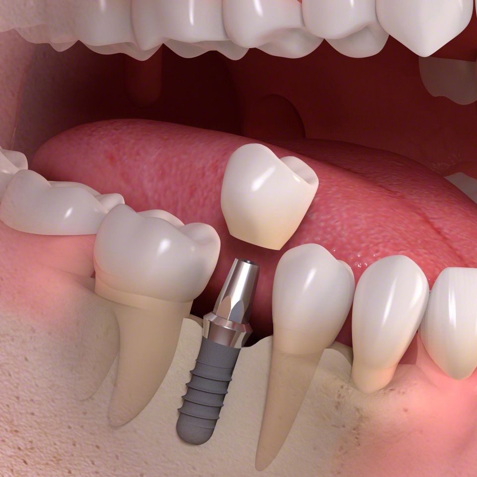 Permanent crown placement on dental implant